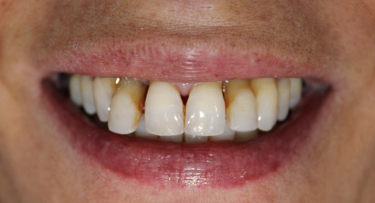 Implantes Dentários All On Four Antes