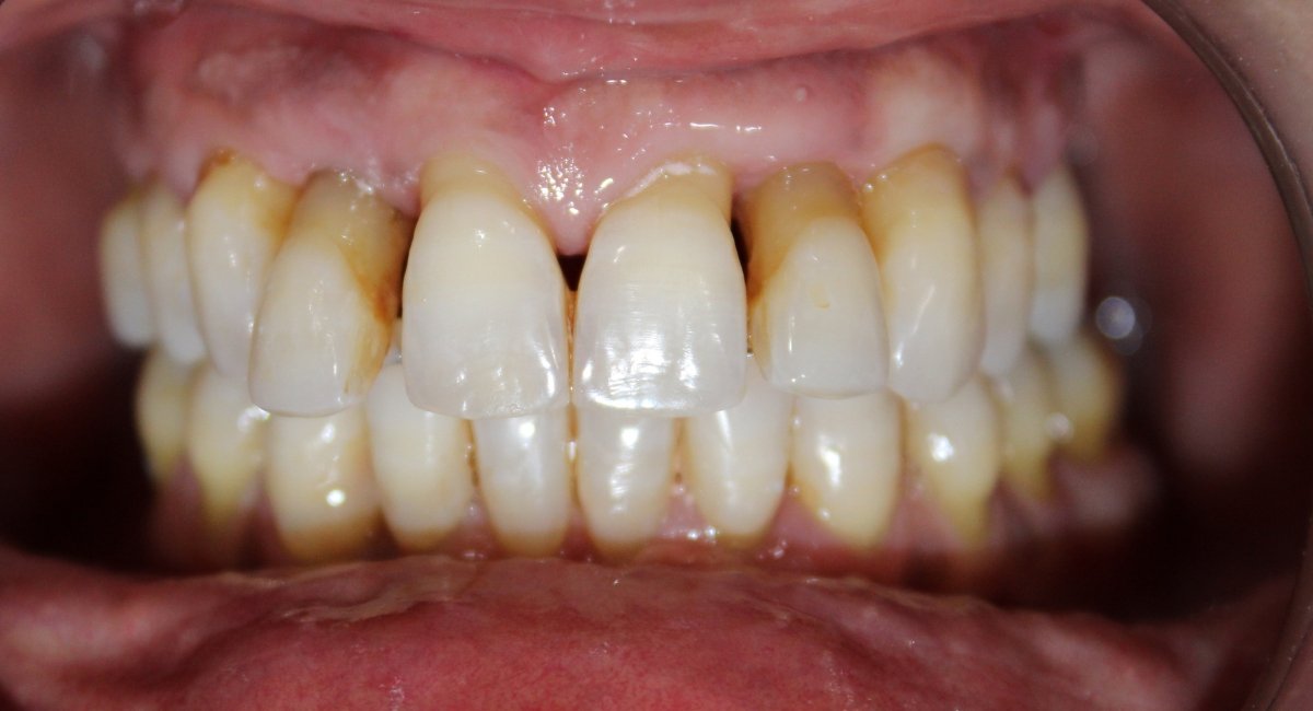 Implantes Dentários All-On-Four Antes