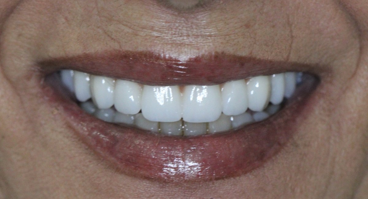 Implantes Dentários All On Four Depois