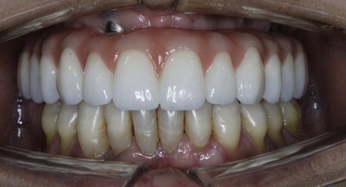 Implantes Dentários All-On-Four Depois