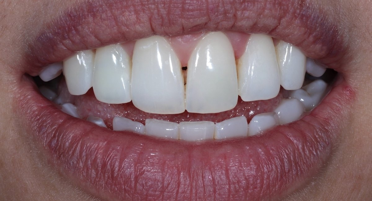 Remoção de Manchas Brancas nos Dentes